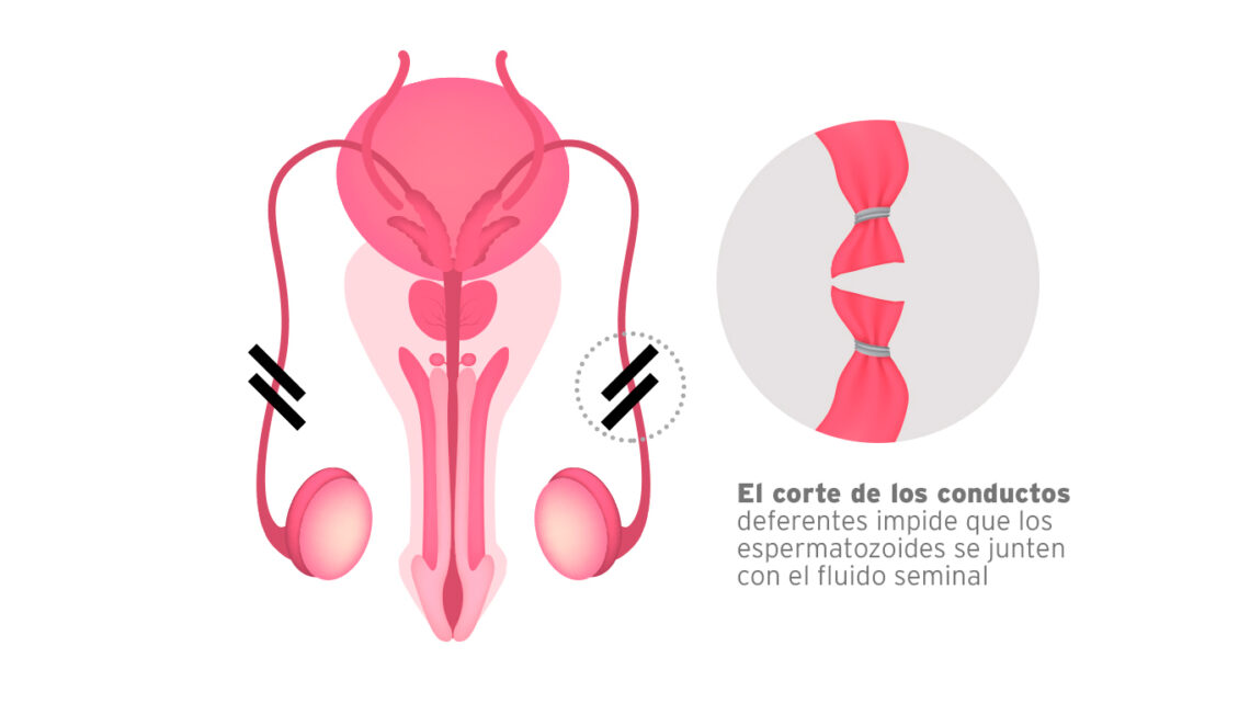 EN 2022 CRECIÓ 66.6% LA DEMANDA DE VASECTOMÍAS EN 2022 CRECIÓ 66.6% LA DEMANDA DE VASECTOMÍAS