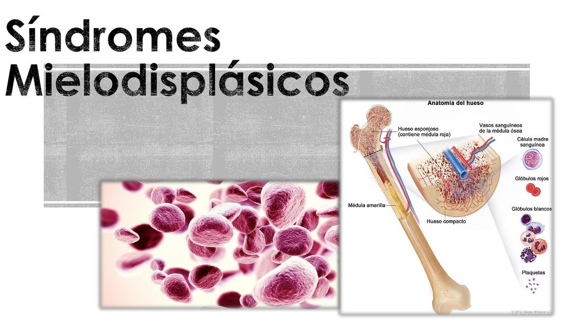 SÍNDROME MIELODISPLÁSICO SÍNDROME MIELODISPLÁSICO