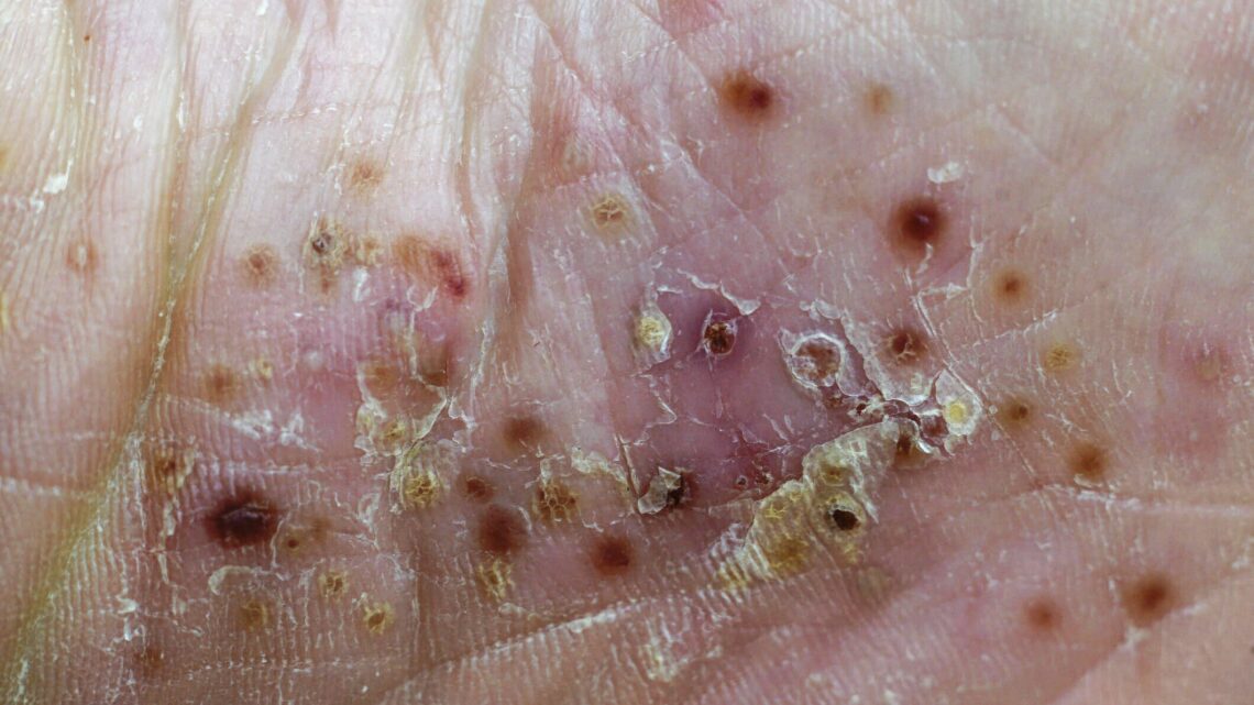 TERAPIA PARA PACIENTES CON PSORIASIS PUSTULOSA GENERALIZADA TERAPIA PARA PACIENTES CON PSORIASIS PUSTULOSA GENERALIZADA