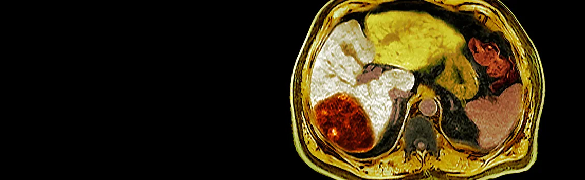 ONCOLOGÍA DE TRASPLANTE