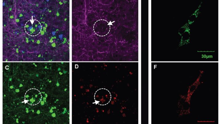 EL CÁNCER DE OVARIO Y LA ENFERMEDAD DE ALZHEIMER TIENEN UN PUNTO EN COMÚN