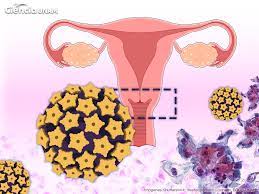 CÁNCER DEL CUELLO UTERINO, ÚNICA NEOPLASIA PREVENIBLE AL 100%