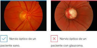 CONSULTAR AL OFTALMÓLOGO DOS VECES AL AÑO PARA ATENDER A TIEMPO EL GLAUCOMA