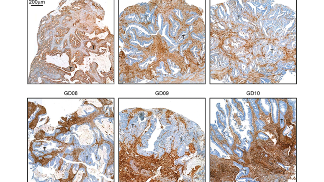 EVALÚA MECANISMOS EN LA ENFERMEDAD DE CROHN EVALÚA MECANISMOS EN LA ENFERMEDAD DE CROHN