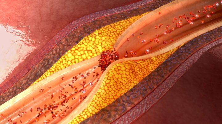 LA ENFERMEDAD DE LAS ARTERIAS CORONARIAS