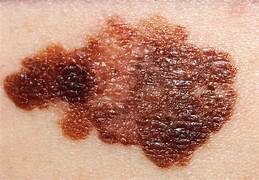 CÁNCER DE PIEL TIPO MELANOMA