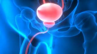 SIGNOS DE CÁNCER DE VEJIGA EN HOMBRES