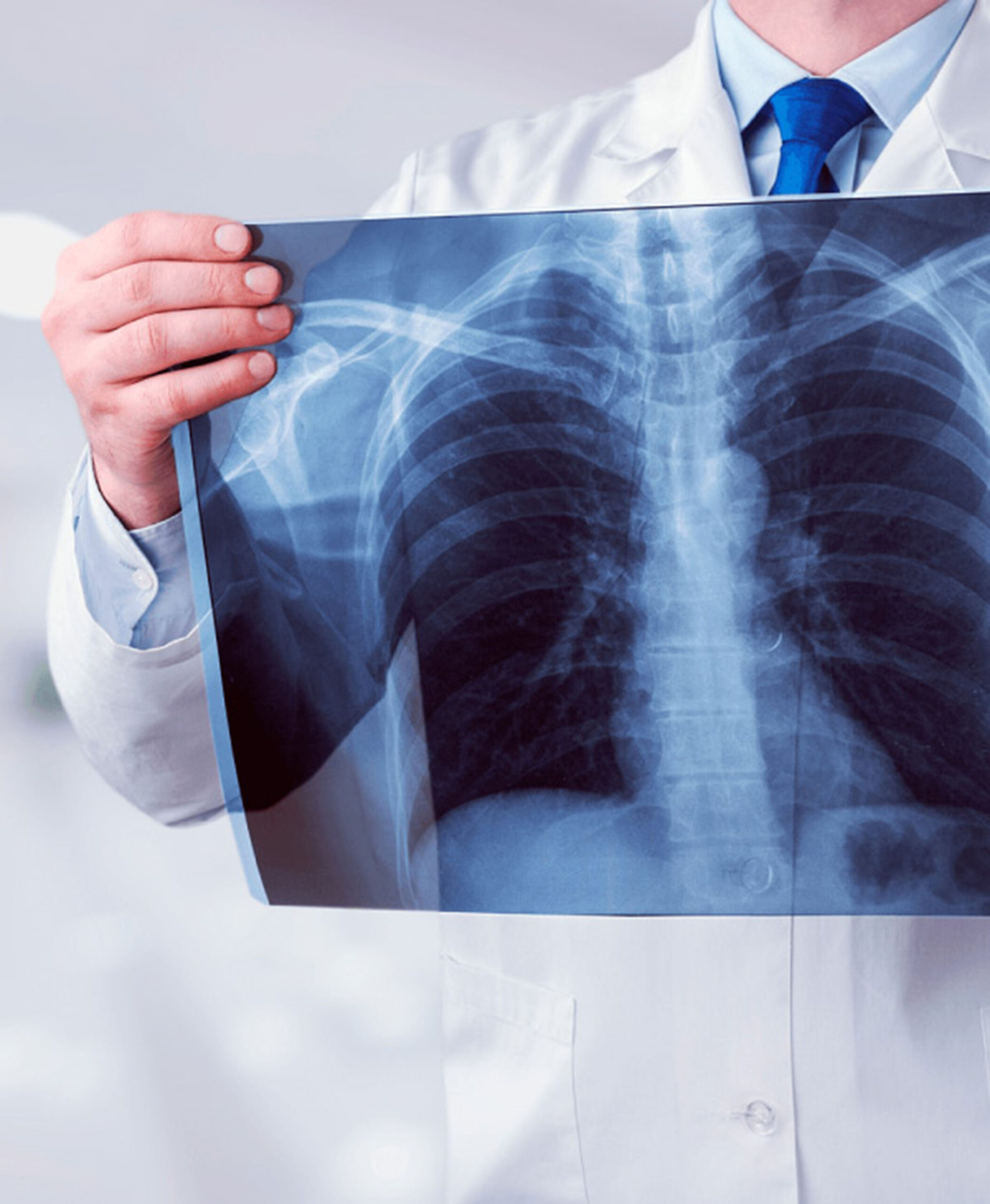 HAY QUE REFORZAR LA VIGILANCIA Y PREVENCIÓN DE LA TUBERCULOSIS