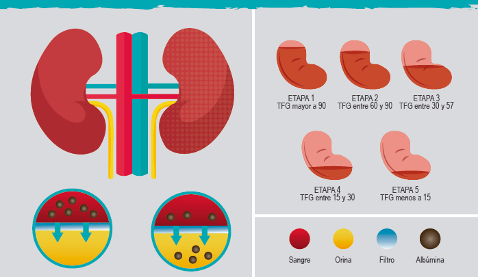 PRIMER PAÍS EN LATINOAMÉRICA CON CONSENSO MÉDICO SOBRE EL USO DE ACA EN ERC