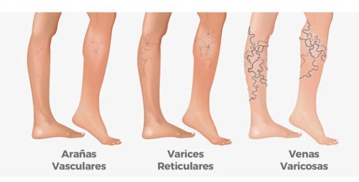 ¿CUÁNDO DEBO PREOCUPARME POR LAS VARICES?