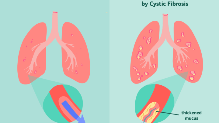 APROBACIÓN DE TRIKAFTA® POR COFEPRIS PARA FIBROSIS QUÍSTICA, CON 2 AÑOS DE EDAD EN ADELANTE