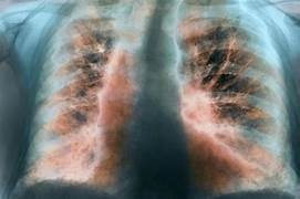 FIBROSIS PULMONAR