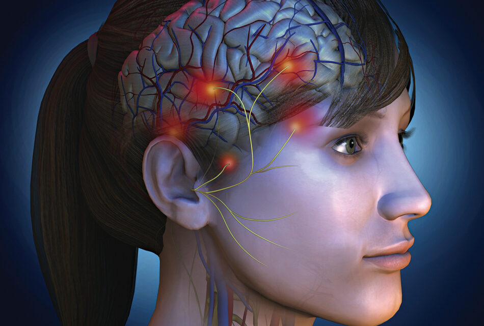 LA MIGRAÑA