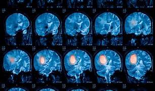 CON LAS MÁS AVANZADAS HERRAMIENTAS DIAGNÓSTICAS Y QUIRÚRGICAS PARA TUMORES CEREBRALES