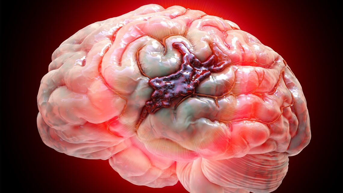 EL ACCIDENTE CEREBROVASCULAR