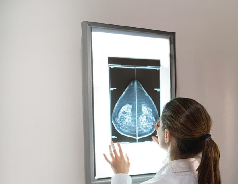 CÁNCER DE MAMA CÁNCER DE MAMA