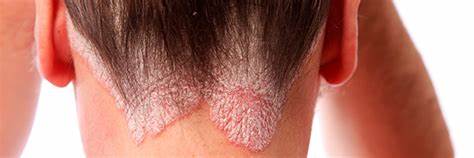 PSORIASIS PUSTULOSA GENERALIZADA PSORIASIS PUSTULOSA GENERALIZADA