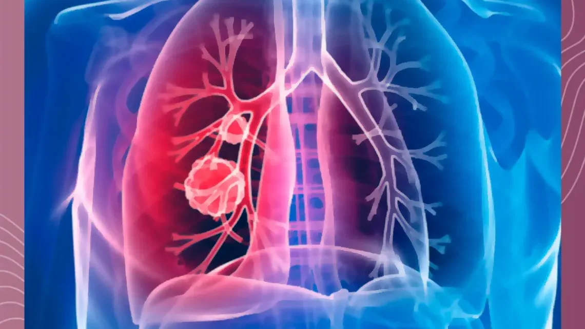 DETECCIÓN DE CÁNCER DE PULMÓN DETECCIÓN DE CÁNCER DE PULMÓN