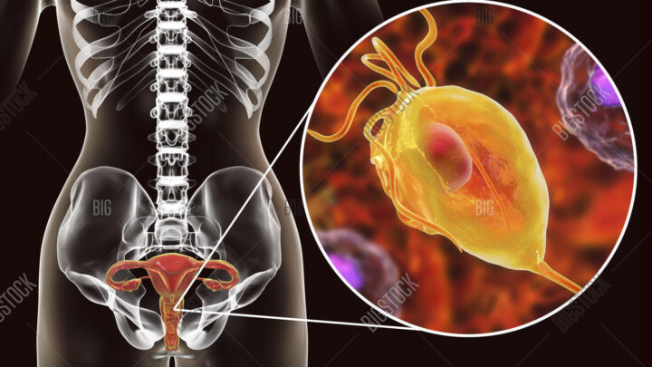 DESARROLLAN PROTOTIPO DE DIAGNÓSTICO RÁPIDO CON MUESTRA SANGUÍNEA PARA TRICHOMONIAISIS