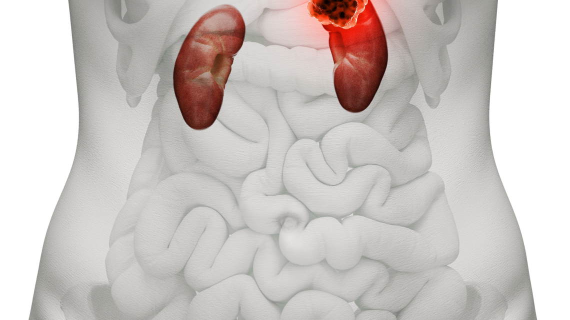 EL CARCINOMA DE CÉLULAS RENALES Y SUS DESAFÍOS