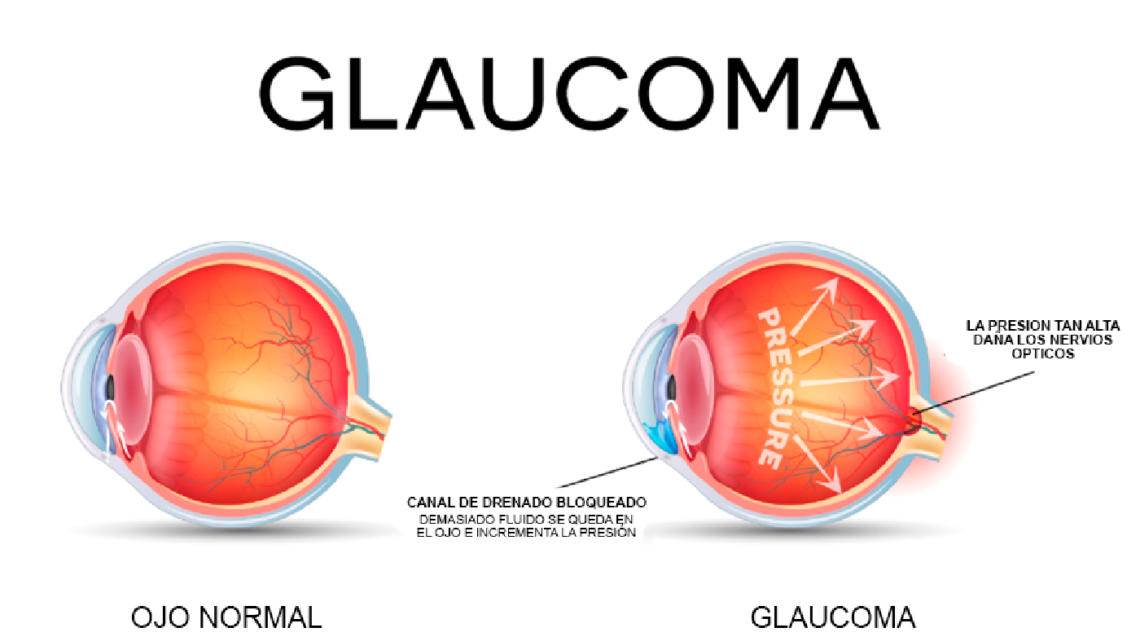ES POSIBLE CONTROLAR EL GLAUCOMA ES POSIBLE CONTROLAR EL GLAUCOMA