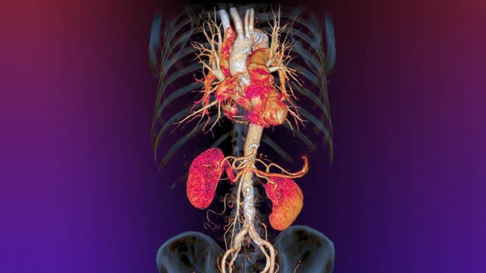 SÍNDROME CARDIOVASCULAR-RENO-METABÓLICO