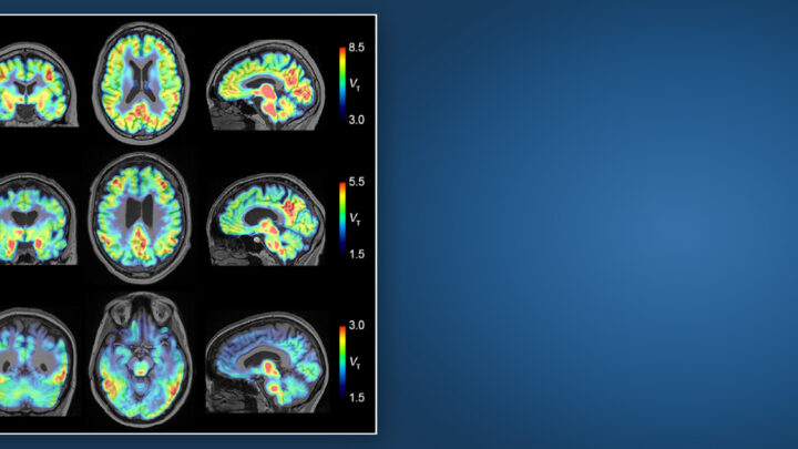 NUEVOS TRAZADORES DE INFLAMACIÓN EN EL ALZHEIMER