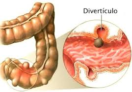 CÓMO SE SIENTE UN EVENTO DE DIVERTICULITIS
