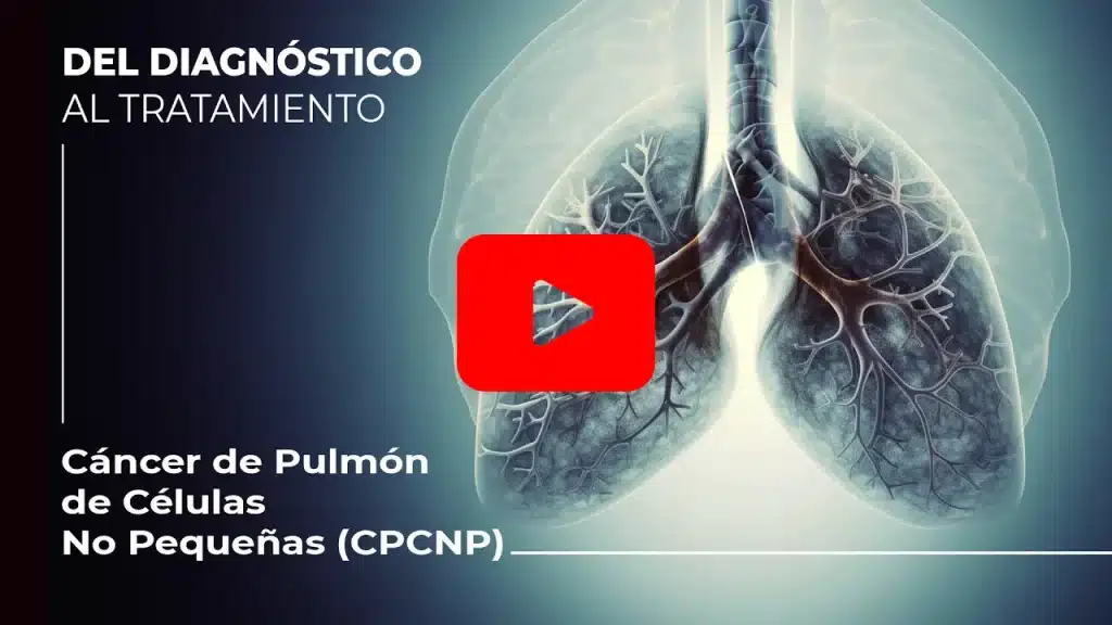 NUEVAS ESPERANZAS CONTRA EL CÁNCER DE PULMÓN AVANZADO