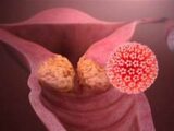 15 AÑOS PARA CONTROLAR EL CÁNCER CERVICOUTERINO
