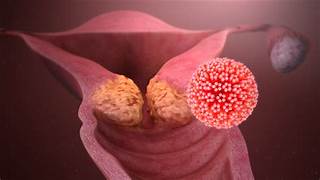 15 AÑOS PARA CONTROLAR EL CÁNCER CERVICOUTERINO