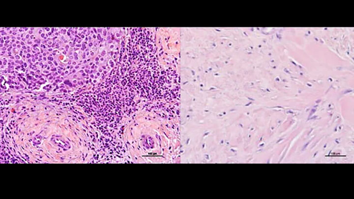 ESTRATEGIA TERAPÉUTICA CONTRA EL CÁNCER DE MAMA METAPLÁSICO