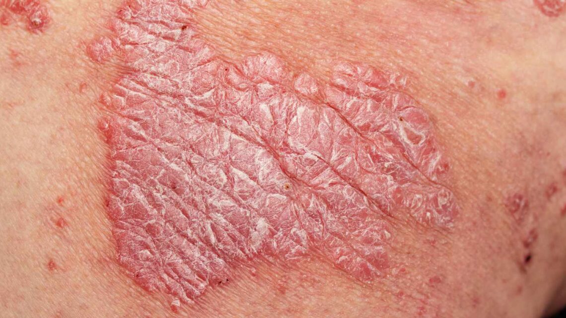 PSORIASIS PSORIASIS