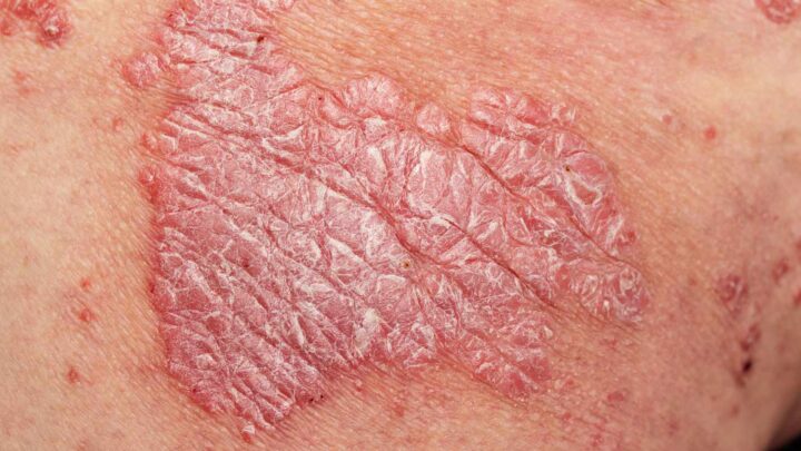 PSORIASIS PSORIASIS