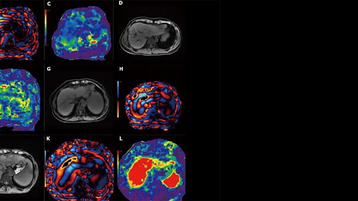 INNOVACIÓN EN RESONANCIA MAGNÉTICA DE SECUENCIA CORTA