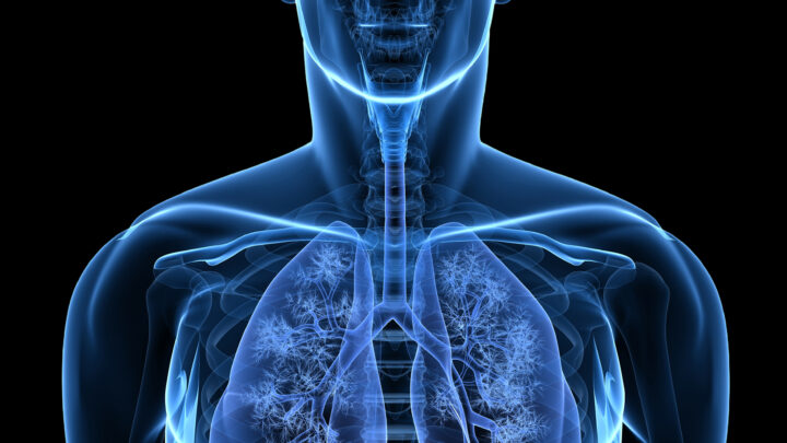 EN CASO DE QUE EL CÁNCER DE COLON LLEGUE AL PULMÓN