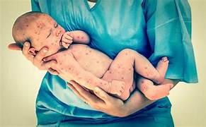 PÉRDIDA DEL ESTATUS DE REGIÓN LIBRE DE SARAMPIÓN, PAÍSES DE LAS AMÉRICAS