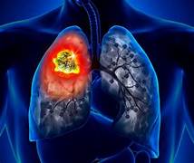 CÓMO DETECTAR LOS SÍNTOMAS DEL CÁNCER DE PULMÓN Y CUÁNDO ACTUAR