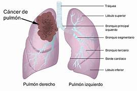 CÁNCER DE PULMÓN