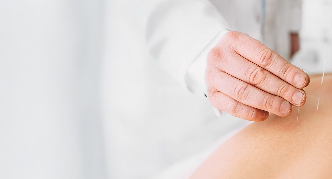 DUDAS SOBRE LA ACUPUNTURA