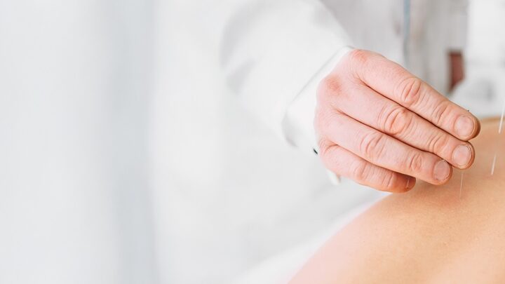 DUDAS SOBRE LA ACUPUNTURA