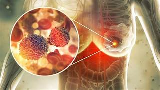 EN DESARROLLO, VACUNAS TERAPÉUTICAS CONTRA CÁNCER DE MAMA