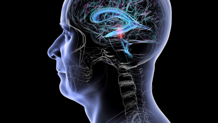 FUGA DE LÍQUIDO EN EL CEREBRO PUEDE IMITAR AL ALZHEIMER