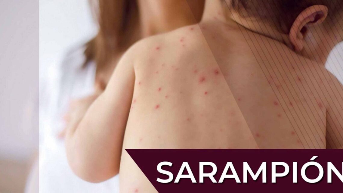 SARAMPIÓN, MÁS CONTAGIOSO QUE LA COVID-19