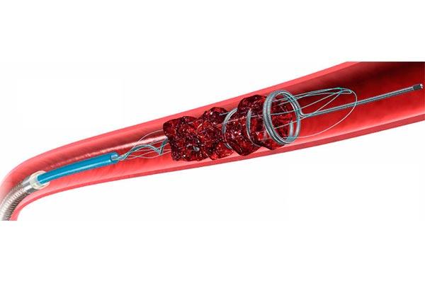 TECNOLOGÍA EN EL TRATAMIENTO DEL ATAQUE CEREBRAL